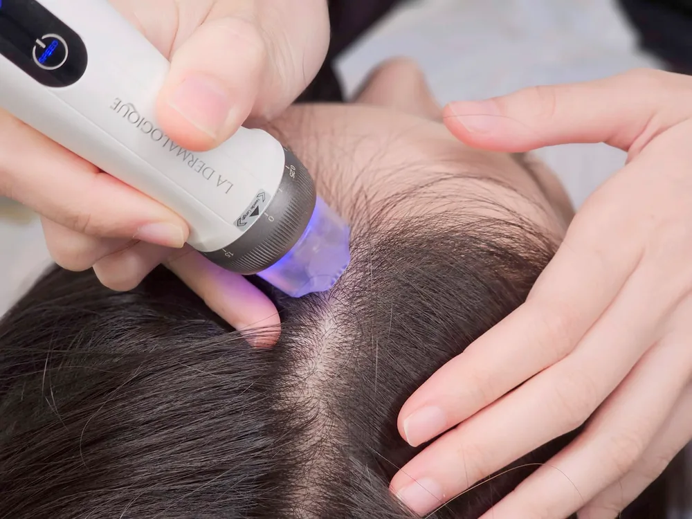 Scalp Microneedling