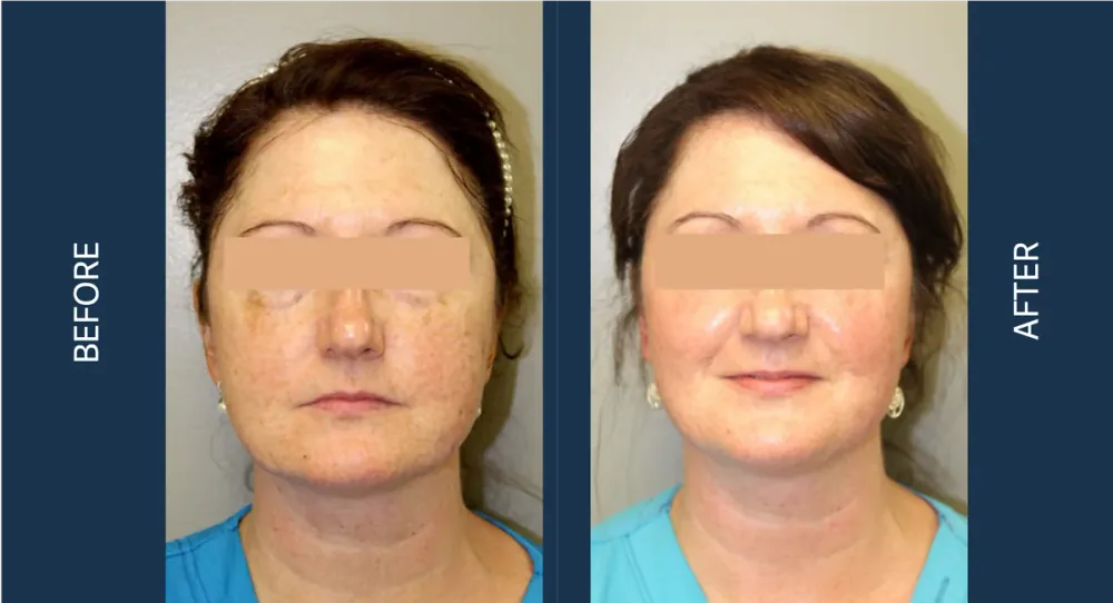 CO2 CoolPeel before and after, front-facing full face view