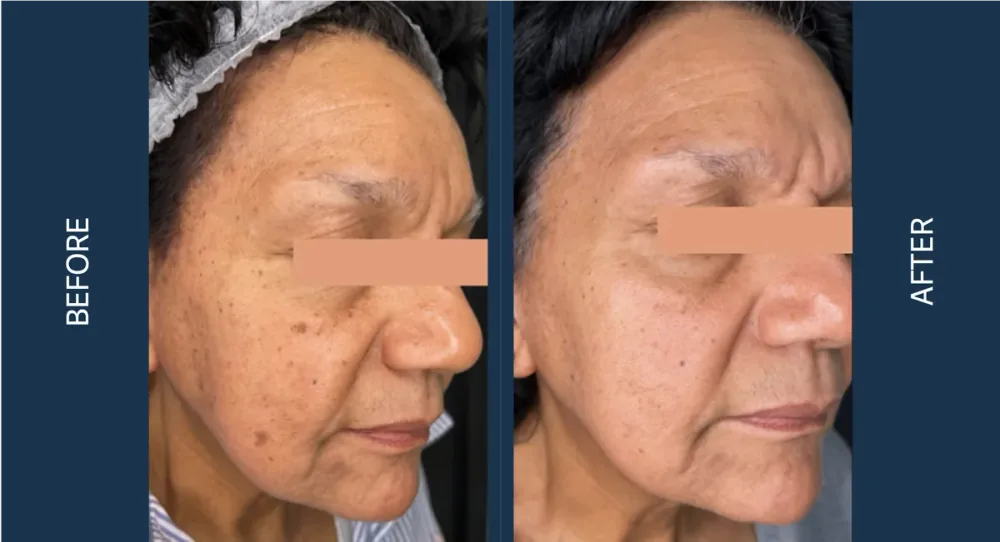 CO2 CoolPeel before and after, profile view showing reduced pigmentation