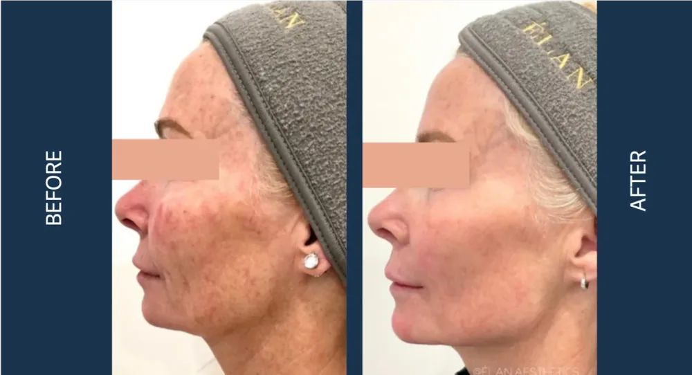 CO2 CoolPeel before and after, profile view showing smoother texture