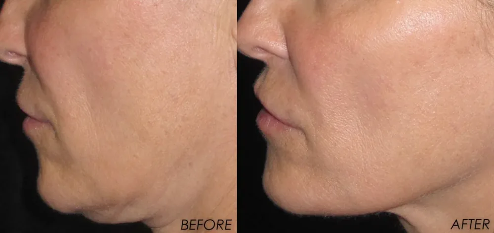 PRP facial before and after, close profile view showing smoother skin texture