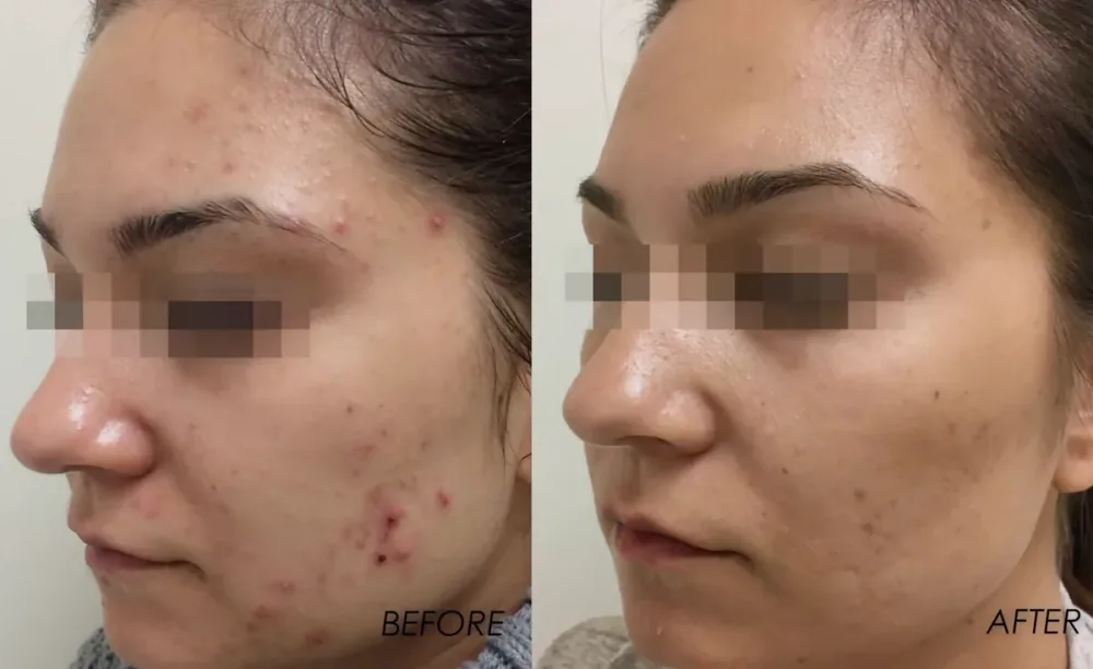 Microneedling before and after, profile view showing improved forehead and cheek texture
