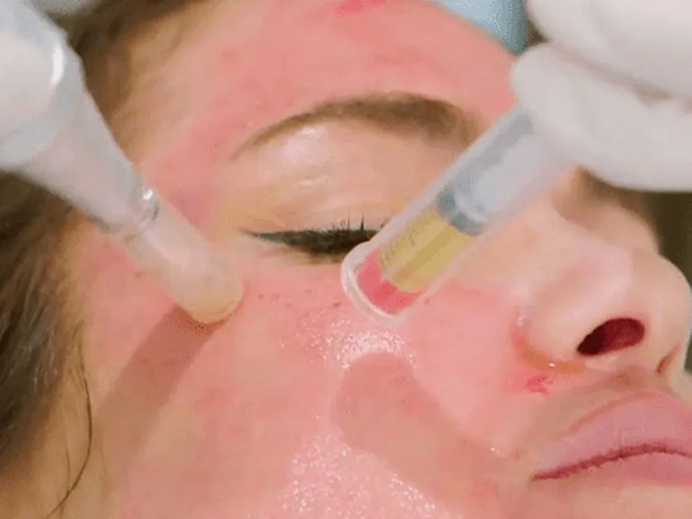 Microneedling w/ PRP