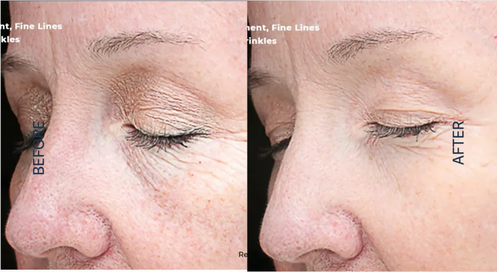 VI Peel before and after result, fine lines and wrinkles