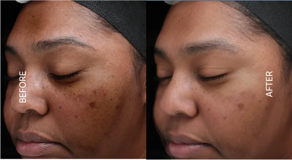VI Peel before and after result, uneven tone and pigmentation
