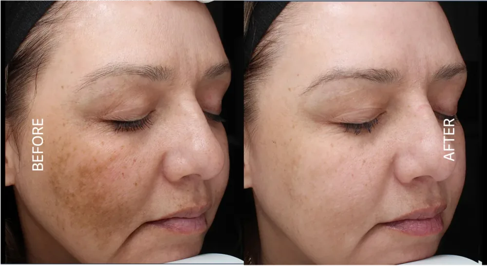 VI Peel before and after result, melasma and dark spots