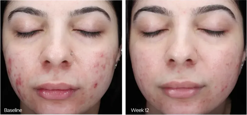 ZO Skin Health before and after, baseline to week 12