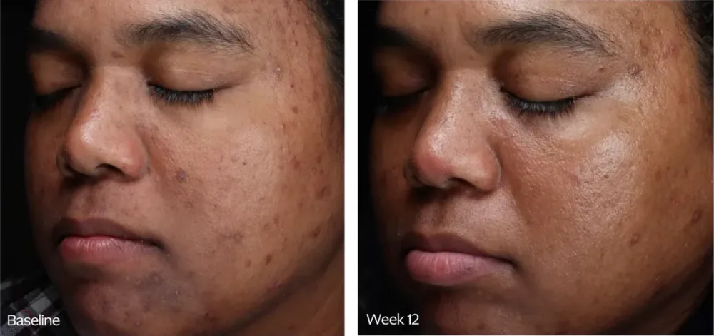 ZO Skin Health before and after, baseline to week 12 profile view