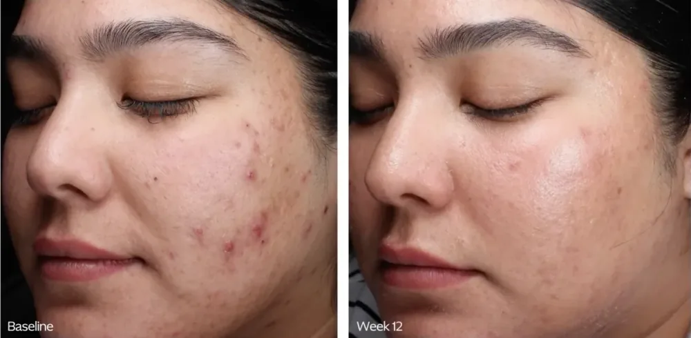 ZO Skin Health before and after, baseline to week 12 profile view