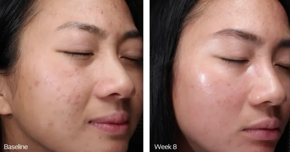 ZO Skin Health before and after, baseline to week 8