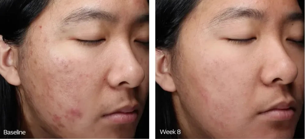 ZO Skin Health before and after, baseline to week 8 closeup