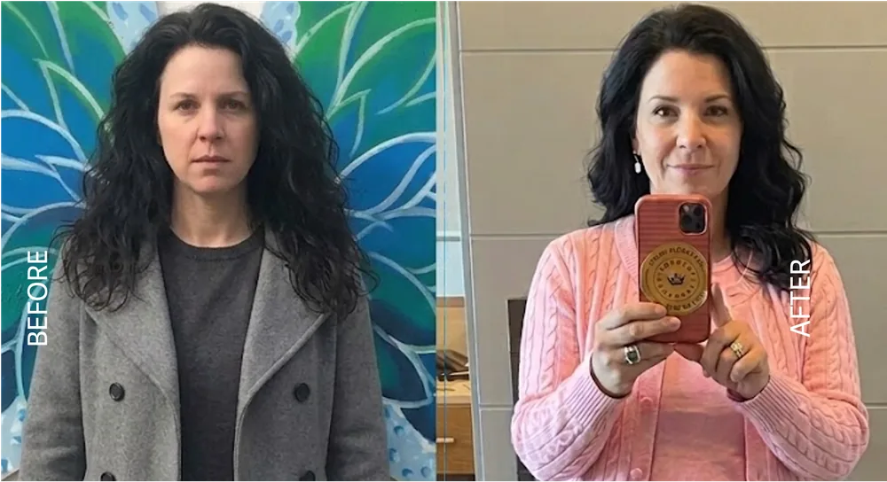 Semaglutide progress journey result, patient 3